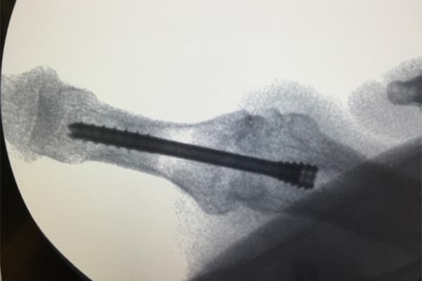 arthrodese metacarpo phalangienne du pouce chirurgie arthrose doigts dr falcone chirurgien orthopedique paris chirurgie main paris