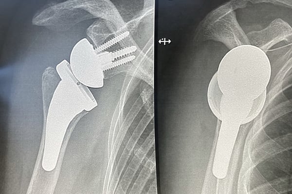 arthroplastie inversee prothese epaule chirurgien orthopediste paris docteur olivier falcone chirurgien epaule paris