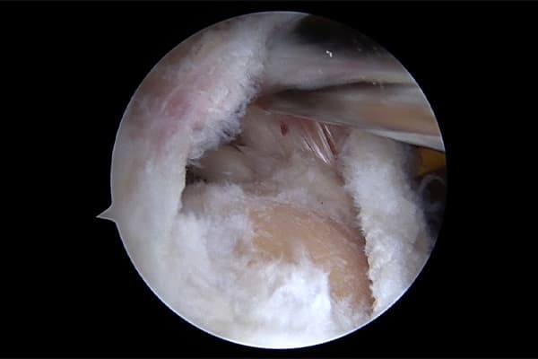 arthroscopie rupture de la coiffe des rotateurs epaule operation epaule chirurgien orthopediste epaule paris dr marc olivier falcone paris