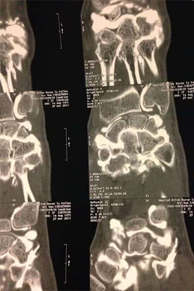 arthrose poignet mediocarpe photos operation poignet chirurgien orthopediste poignet main paris docteur marc olivier falcone paris