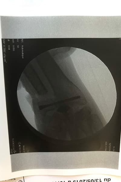 arthrose poignet traitement rcpi photos dr falcone chirurgien orthopedique paris chirurgie poignet main paris