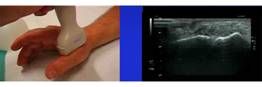 articulation metatarso phalangienne douleur echographie entorse du pouce que faire chirurgien orthopediste main poignet paris docteur marc olivier falcone paris