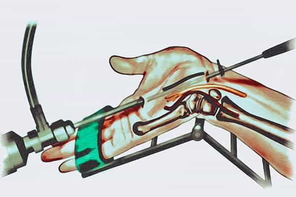 chirurgie nerf canal carpien main chirurgien orthopediste mains poignet paris docteur marc olivier falcone paris