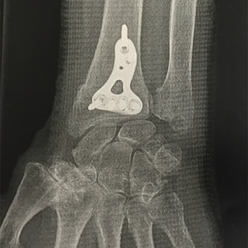 chirurgie poignet plaques maladie de kienbock dr falcone chirurgien orthopedique paris chirurgie poignet main paris