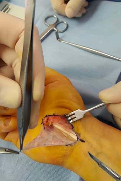 chirurgie rhumatoides main poignet synovectomie flechisseur dr falcone chirurgien orthopedique paris chirurgie main paris