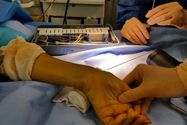 chirurgie scaphoide poignet per cut per op dr falcone chirurgien orthopedique paris chirurgie poignet main paris
