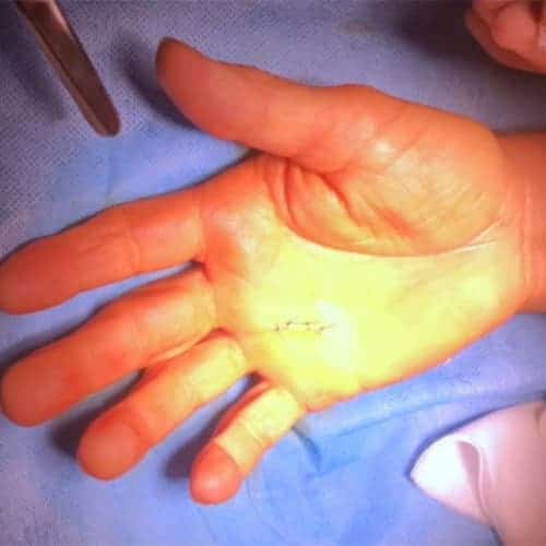 cicatrice classique operation doigt a ressaut dr falcone chirurgien orthopedique paris chirurgie main paris