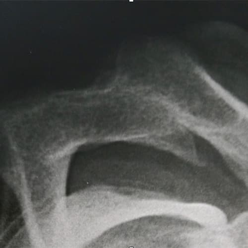 comment soigner une arthrose acromio claviculaire traitement operation epaule chirurgien orthopediste epaule paris docteur olivier falcone paris