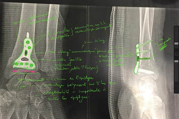 conception plaque vissee mini invasive fracture radius dr falcone chirurgien orthopedique paris chirurgie poignet main paris