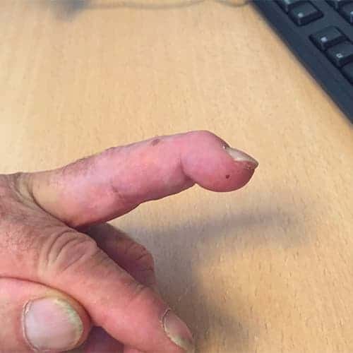 doigt en maillet ou mallet finger rhumatoide chirurgien orthopediste main poignet paris docteur marc olivier falcone paris