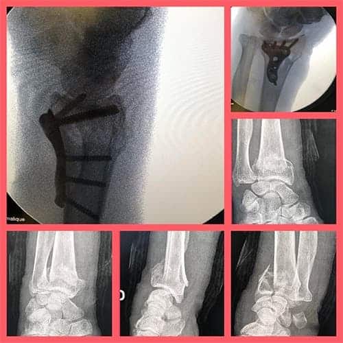 douleurs apres fracture radius chirurgie mini invasive plaque vissee dr falcone chirurgien orthopedique paris chirurgie poignet main paris