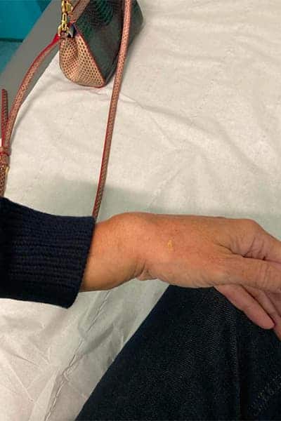 fracture poignet radius image chirurgien orthopediste poignet main paris docteur marc olivier falcone paris