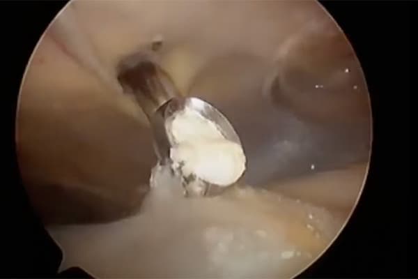 operation calcification epaule arret travail dr falcone chirurgien orthopedique paris chirurgie epaule paris