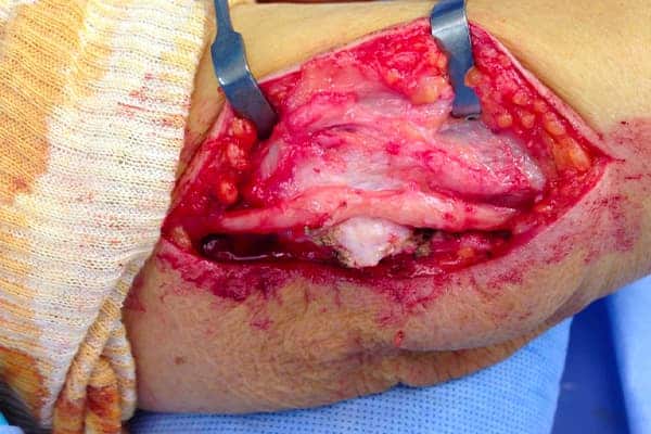 operation compression nerf ulnaire coude douleur chirurgien orthopediste du coude paris docteur marc olivier falcone paris