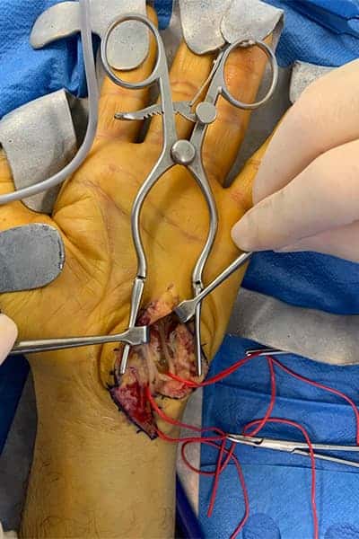 operation syndrome du canal de guyon liberation nerf ulnaire dr falcone chirurgien orthopedique paris chirurgie main paris