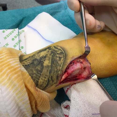 operation tendons extenseurs poignet chirurgie spinner kapplan rhumatoides main poignet dr falcone chirurgien orthopedique paris chirurgie main paris