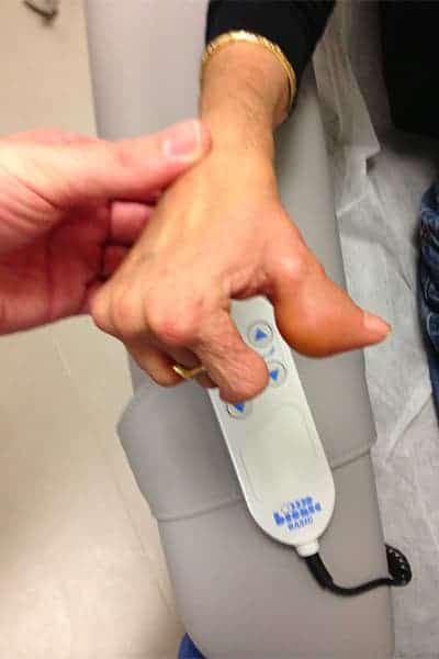 photo nodules rhumatoides doigt photos traitement efficace chirurgien orthopediste main poignet paris docteur marc olivier falcone paris
