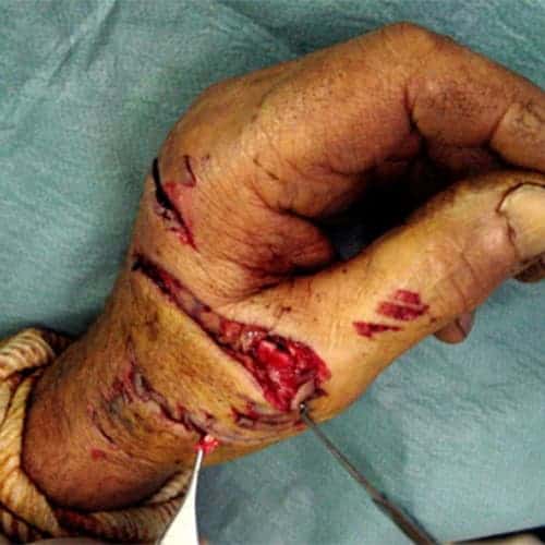 photo urgence sos mains accident dos de la main chirurgien orthopediste poignet main paris docteur marc olivier falcone paris