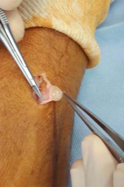photos tumeur schwannomes douloureux traitement de la main chirurgien orthopediste main poignet paris docteur marc olivier falcone paris