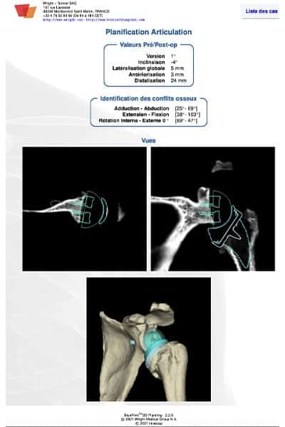 prothese epaule guide omarthrose blue print chirurgien orthopediste paris docteur olivier falcone chirurgien epaule paris
