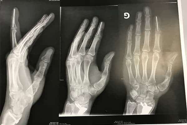 radio arthrodese interphalangienne distale tratement arthose doigts dr falcone chirurgien orthopedique paris chirurgie main paris