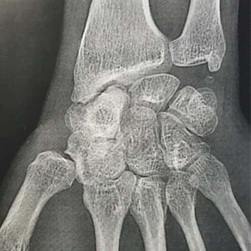 radio arthrose du poignet chirurgien orthopediste poignet main paris docteur marc olivier falcone paris