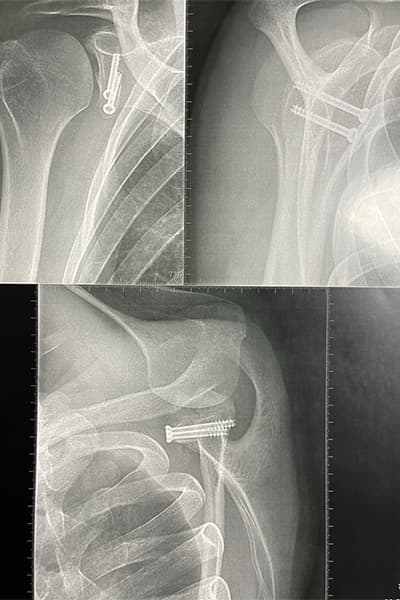radio instabilite de l epaule traitement butee de latarget dr falcone chirurgien orthopedique paris chirurgie epaule paris