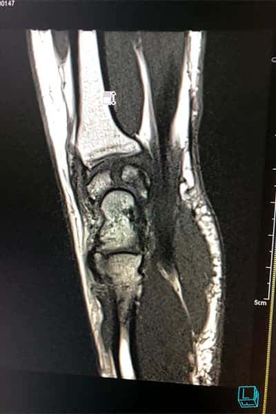 radio maladie du poignet de kienbock causes chirurgien orthopediste poignet main paris docteur marc olivier falcone paris