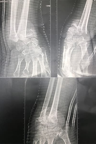 radiographie fracture radius poignet chirurgien orthopediste poignet main paris docteur marc olivier falcone paris