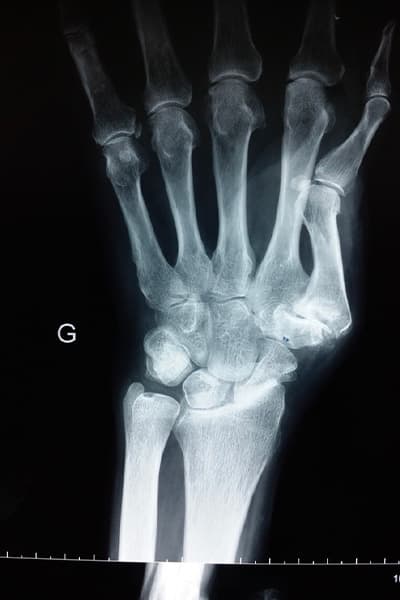 radiographie rhizarthrose du pouce symptomes chirurgie de la main chirurgien orthopediste main poignet paris docteur marc olivier falcone paris