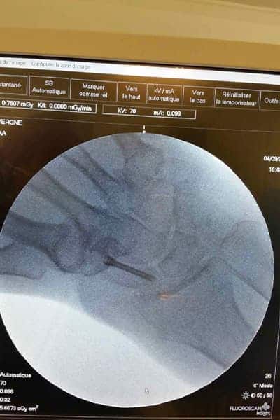 radiographie scaphoide fracture vissage dr falcone chirurgien orthopedique paris chirurgie poignet main paris