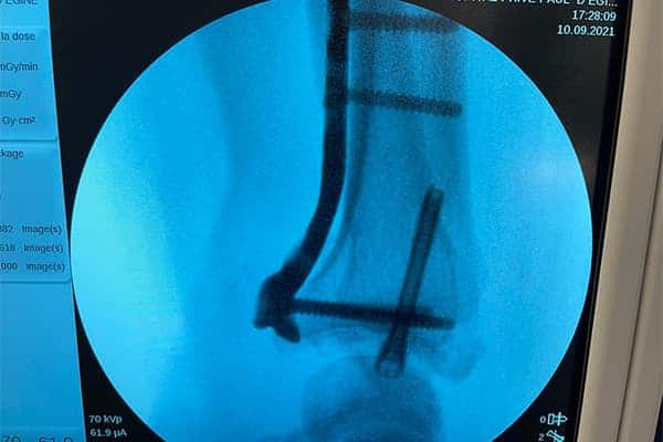 reconstruction fracture radius temps consolidation dr falcone chirurgien orthopedique paris chirurgie poignet main paris