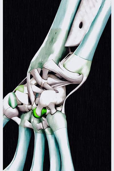 schema calcification ligament triangulaire du carpe poignet chirurgien orthopediste poignet main paris docteur marc olivier falcone paris