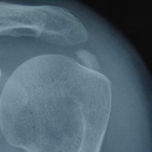 tendinite calcifiante calcification epaule symptomes operation epaule chirurgien orthopediste epaule paris dr marc olivier falcone paris