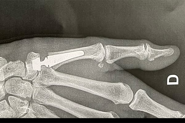 traitement rhizarthrose du pouce operation main chirurgien orthopediste main poignet paris docteur marc olivier falcone paris