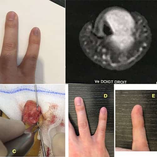 tumeur glomique doigt photo avant apres operation chirurgien orthopediste main poignet paris docteur marc olivier falcone paris