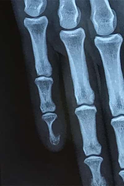 tumeur glomique doigts symptomes radiographie chirurgien orthopediste main poignet paris docteur marc olivier falcone paris