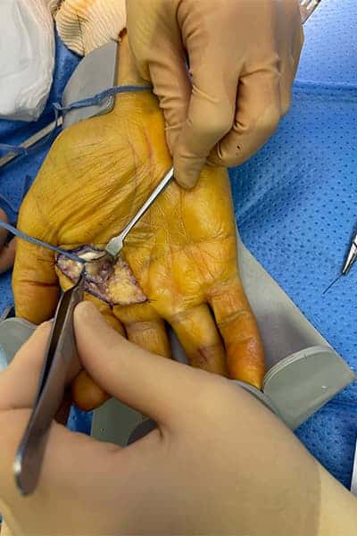 tumeur osseuse benigne traitement osteome osteoide chirurgien orthopediste main poignet paris docteur marc olivier falcone paris