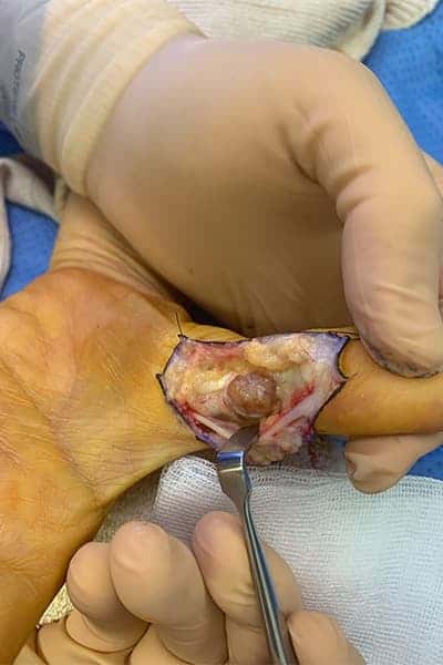 tumeurs a cellules geantes pouce traitement doigt chirurgien orthopediste main poignet paris docteur marc olivier falcone paris