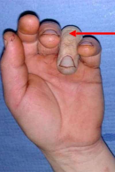 urgence doigt qui deviennent blanc accident main chirurgien orthopediste poignet main paris docteur marc olivier falcone paris