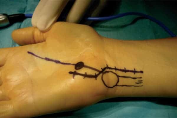 voie canal de guyon nerf ulnaire operation poignet dr falcone chirurgien orthopedique paris chirurgie main paris