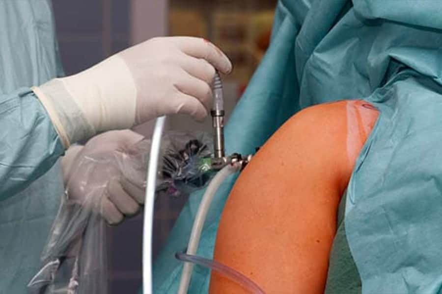 prothese d epaule anatomique ou inversee chirurgie de l epaule dr falcone chirurgien specialiste epaule paris