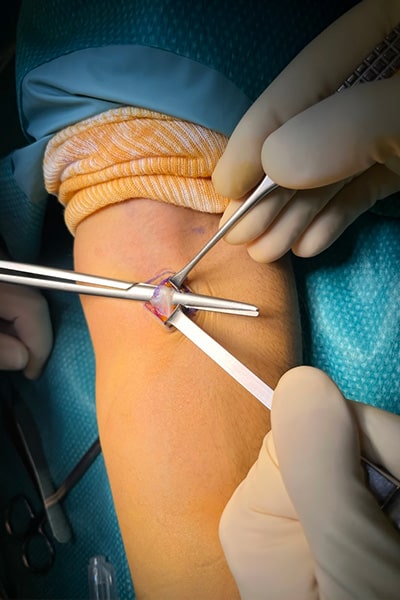 cicatrice bloc operation lacertus fibrosus chirurgie orthopedique de la main paris docteur marc olivier falcone chirurgien membre superieur