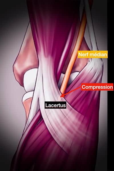 lacertus fibrosus syndrome symptomes maladie chirurgien orthopediste de la main paris docteur marc olivier falcone paris