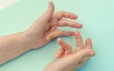 Spécificités de la maladie de Dupuytren chez la femme