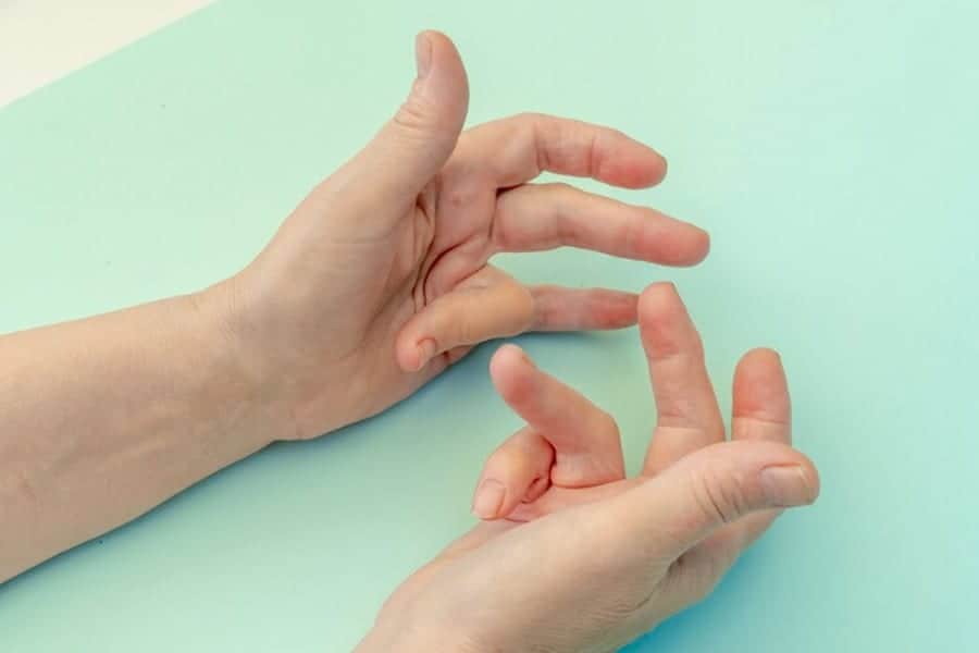 maladie de dupuytren chez la femme falcone chirurgie main epaule paris chirurgien orthopediste main epaule paris