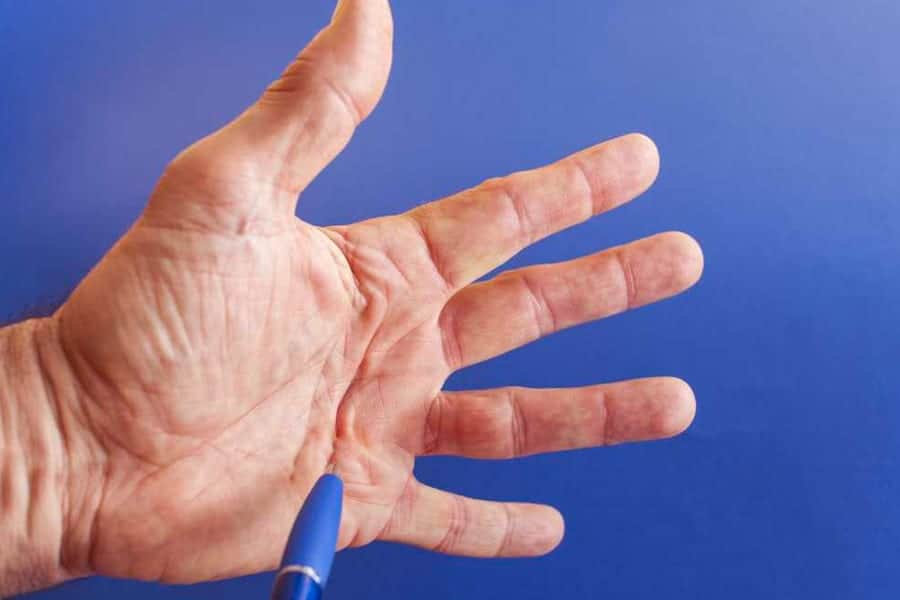 symptomes maladie dupuytren falcone chirurgie main epaule paris chirurgien orthopediste main epaule paris