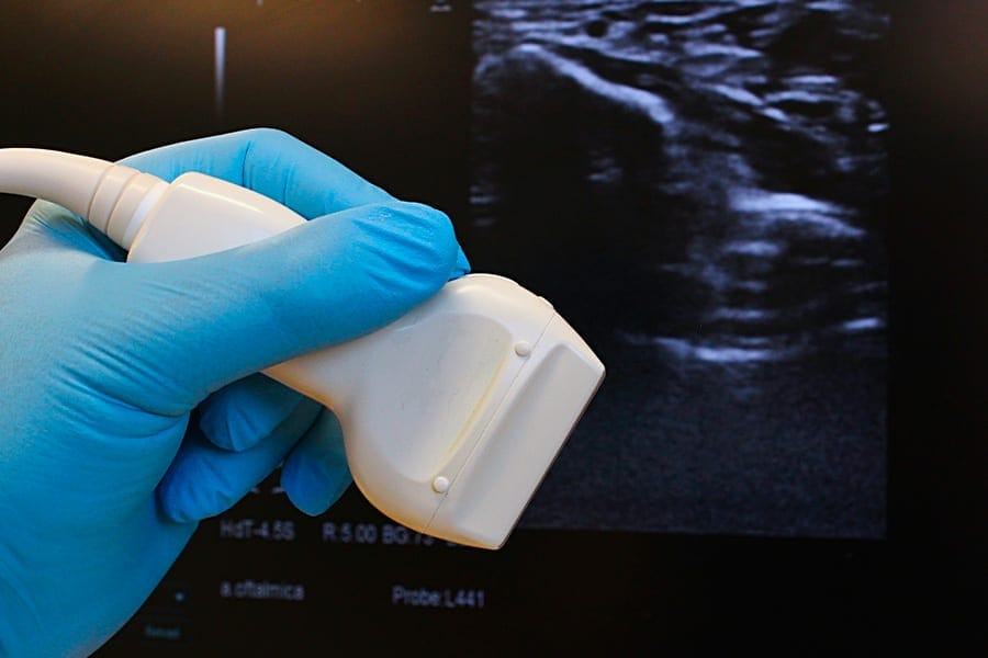 echographie canal carpien chirurgie de la main paris docteur marc olivier falcone chirurgien orthopediste main epaule paris
