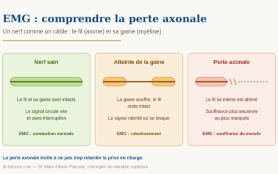 EMG et perte axonale : comprendre votre résultat