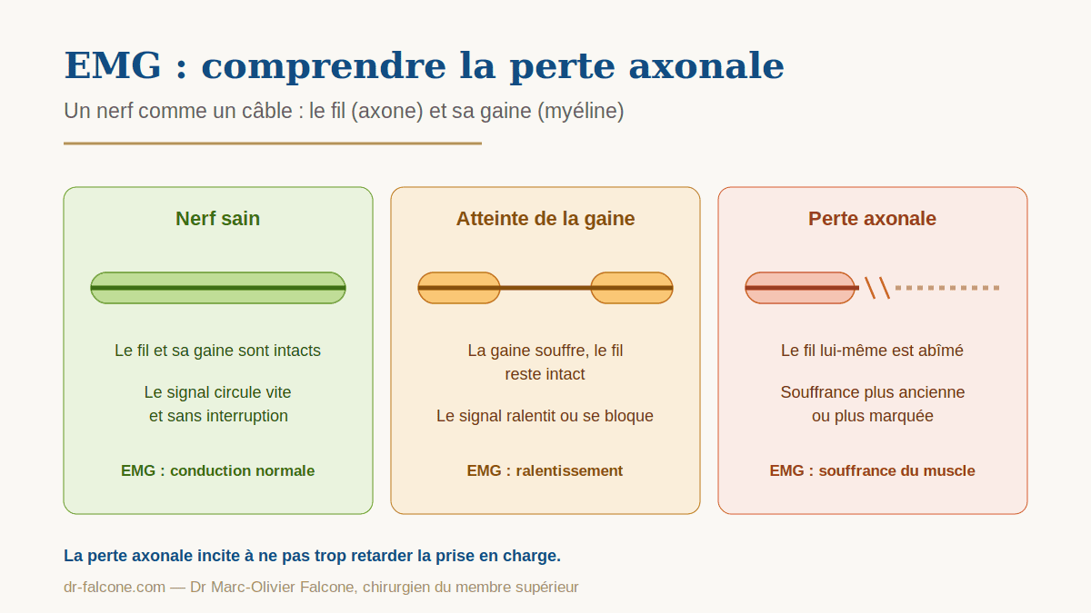 EMG – nerf sain, atteinte de la gaine, perte axonale Comparaison de trois états d'un nerf à l'EMG : nerf sain, atteinte de la gaine de myéline et perte axonale